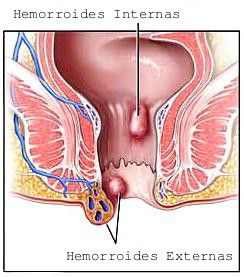 Dibujo hemorroides.jpg
