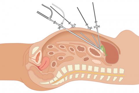 Laparoscopia.jpg