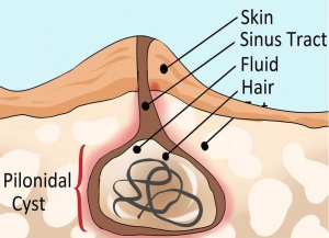 Pilonidal-Cyst.jpg