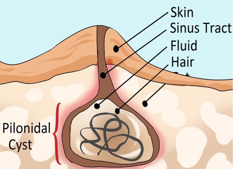 Archivo:Pilonidal-Cyst.jpg