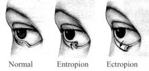 Ecto-entropion.jpg